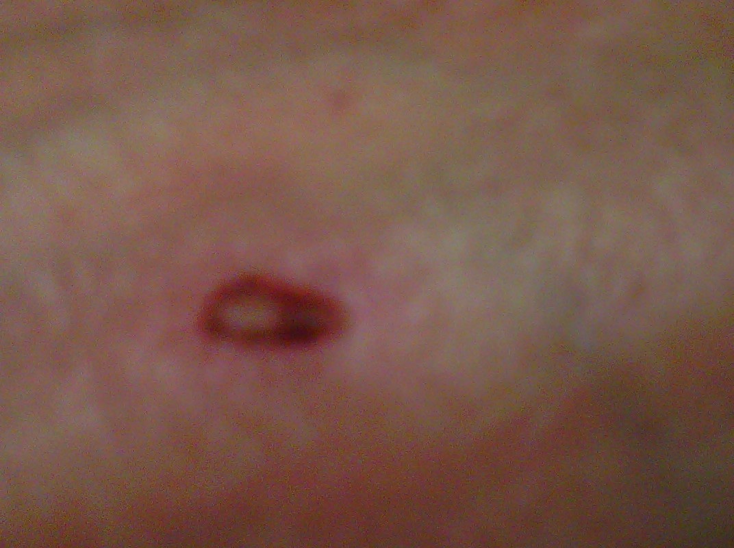 This is just one of the various open sores that appear on Pam's body.  